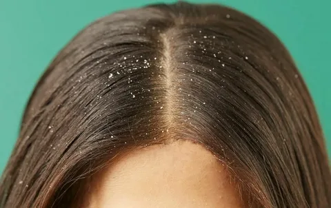 Dandruff